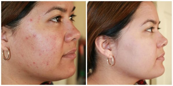 best makeup for acne blemish skin